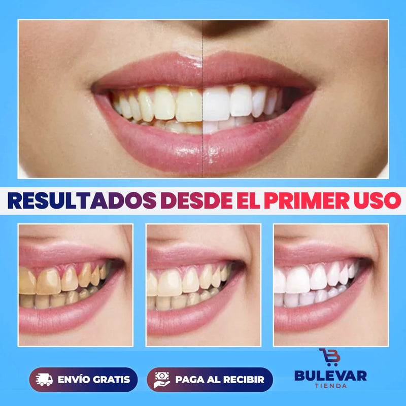 KIT BLANQUEAMIENTO DENTAL EN CASA